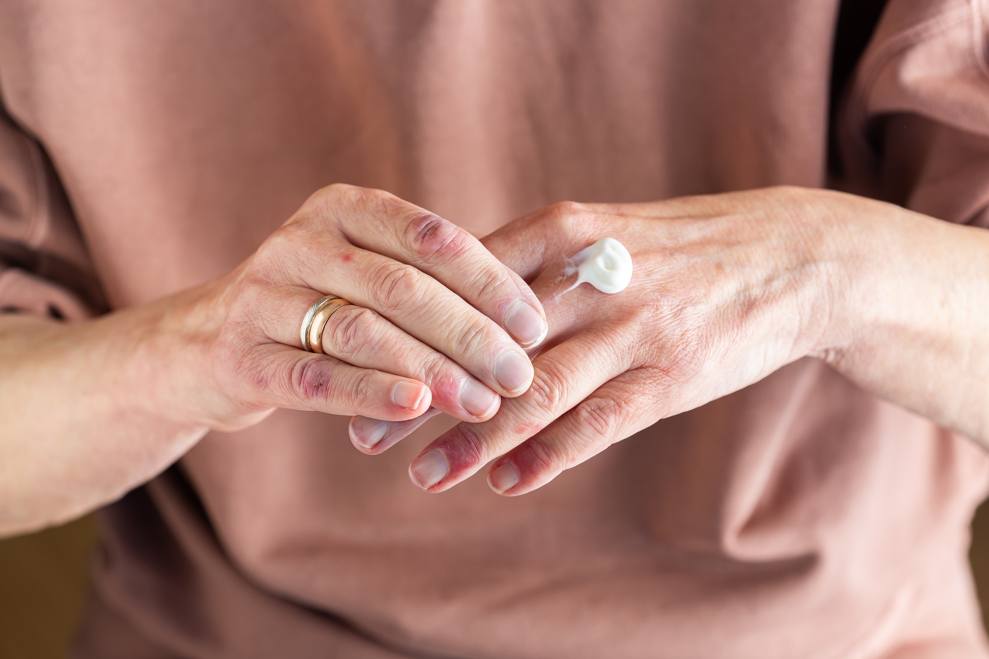 Applying ointment to hands with atopic dermatitis, eczema, allergy