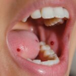 découvrez les causes possibles des boules de sang dans la bouche et les signes qui nécessitent une consultation médicale urgente pour votre santé.