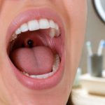 découvrez les causes possibles d'une boule noire dans la bouche et obtenez des conseils pratiques pour améliorer votre hygiène buccale et prévenir les problèmes dentaires.