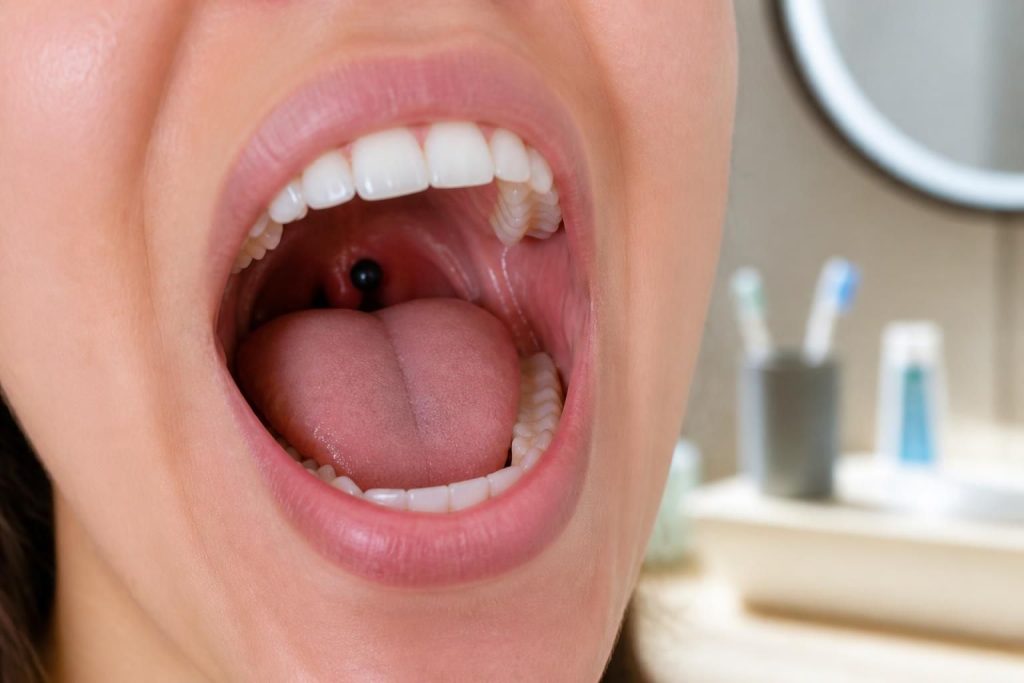découvrez les causes possibles d'une boule noire dans la bouche et obtenez des conseils pratiques pour améliorer votre hygiène buccale et prévenir les problèmes dentaires.
