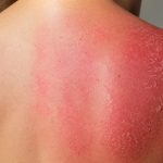 découvrez les symptômes courants de l'érythème solaire et son évolution pour mieux prévenir et traiter cette brûlure de la peau causée par l'exposition au soleil.