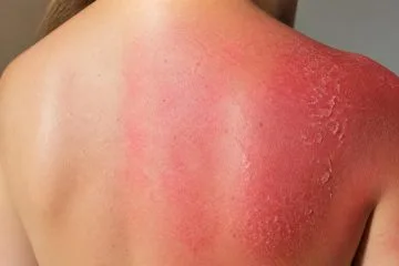 Érythème solaire : symptômes et évolution