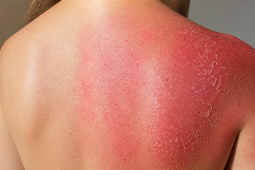 découvrez les symptômes courants de l'érythème solaire et son évolution pour mieux prévenir et traiter cette brûlure de la peau causée par l'exposition au soleil.